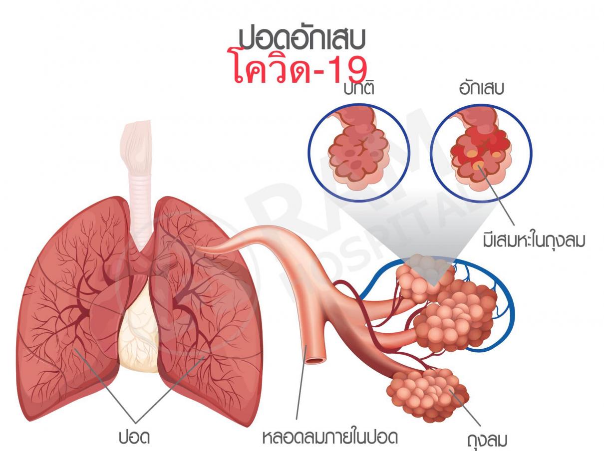 เชื้อไวรัสโควิด-19 เป็นกลุ่มก้อน